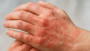 Egzama tamamen geçer mi