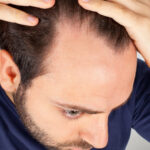 Saç Dökülmesi Tedavisi