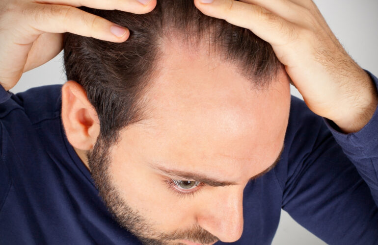 Saç Dökülmesi Tedavisi